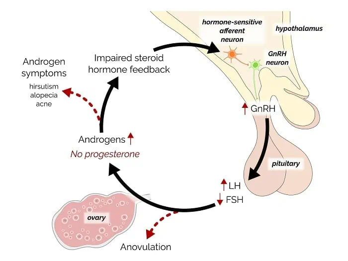 Neuroendocrine disturbance in PCOS